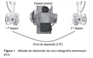 Radiografía estereoscópica